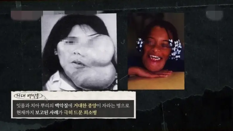 거대백악종