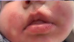 화상 물집 치료방법