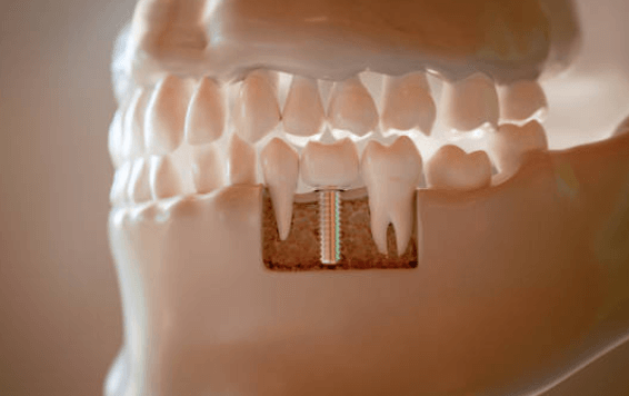 잇몸 고름 임플란트 후 나타날 수 있는 증상들