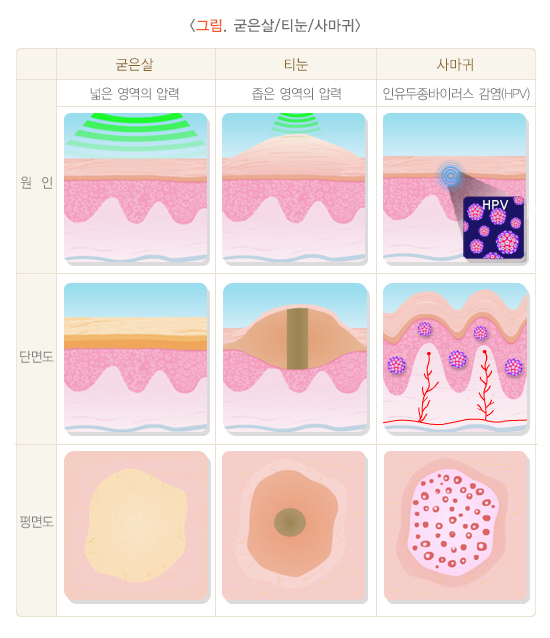 굳은살, 티눈, 사마귀