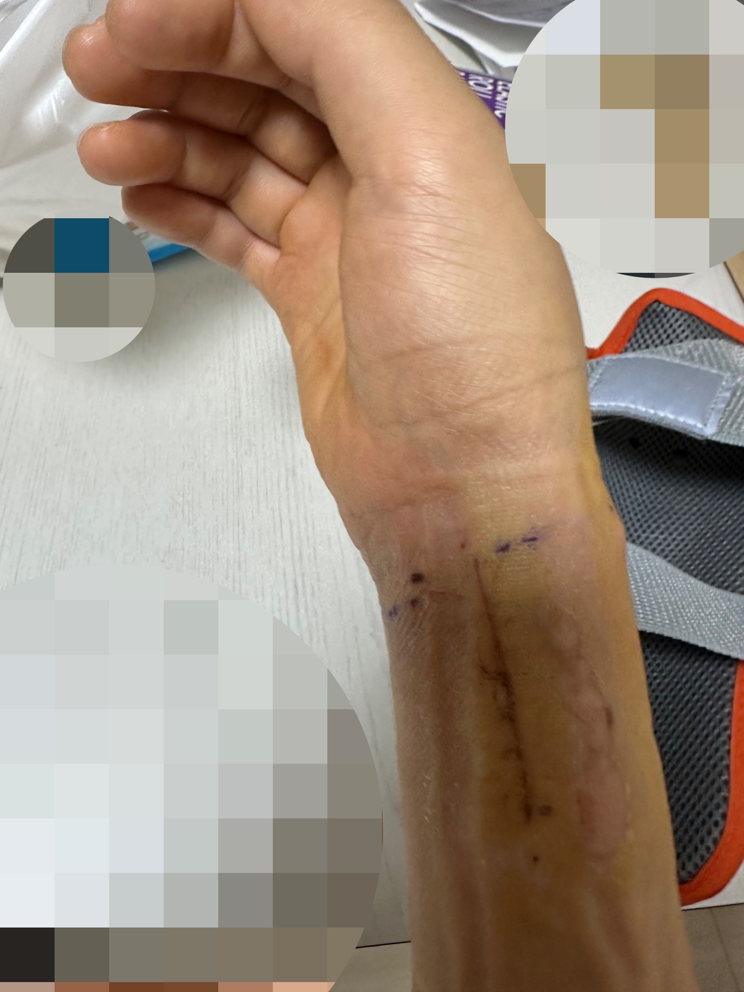 붕대풀고나서-본-모습