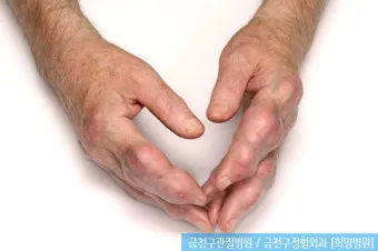 발가락 통풍 증상 및 대처방법_16