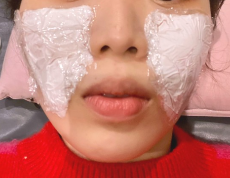 팔자 보톡스 후기