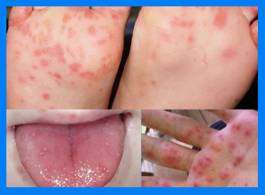 수족구병. 손발입 병소. 반점 수포