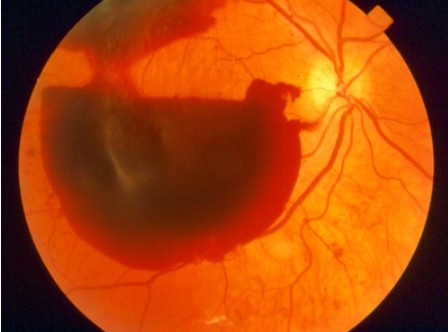 유리체 출혈된 모습