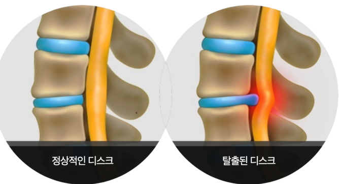 허리디스크 증상
