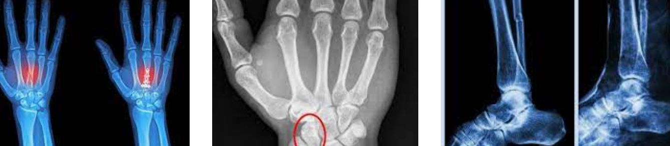 뼈 실금을 보여주는 엑스레이 사진 3장