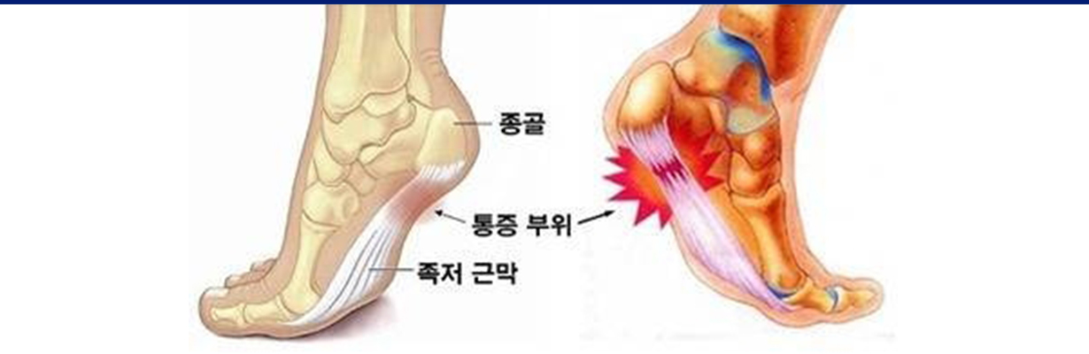 족저근막염 증상