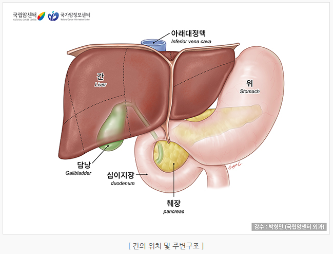 간암