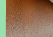 땀띠 원인과 증상 &amp; 치료