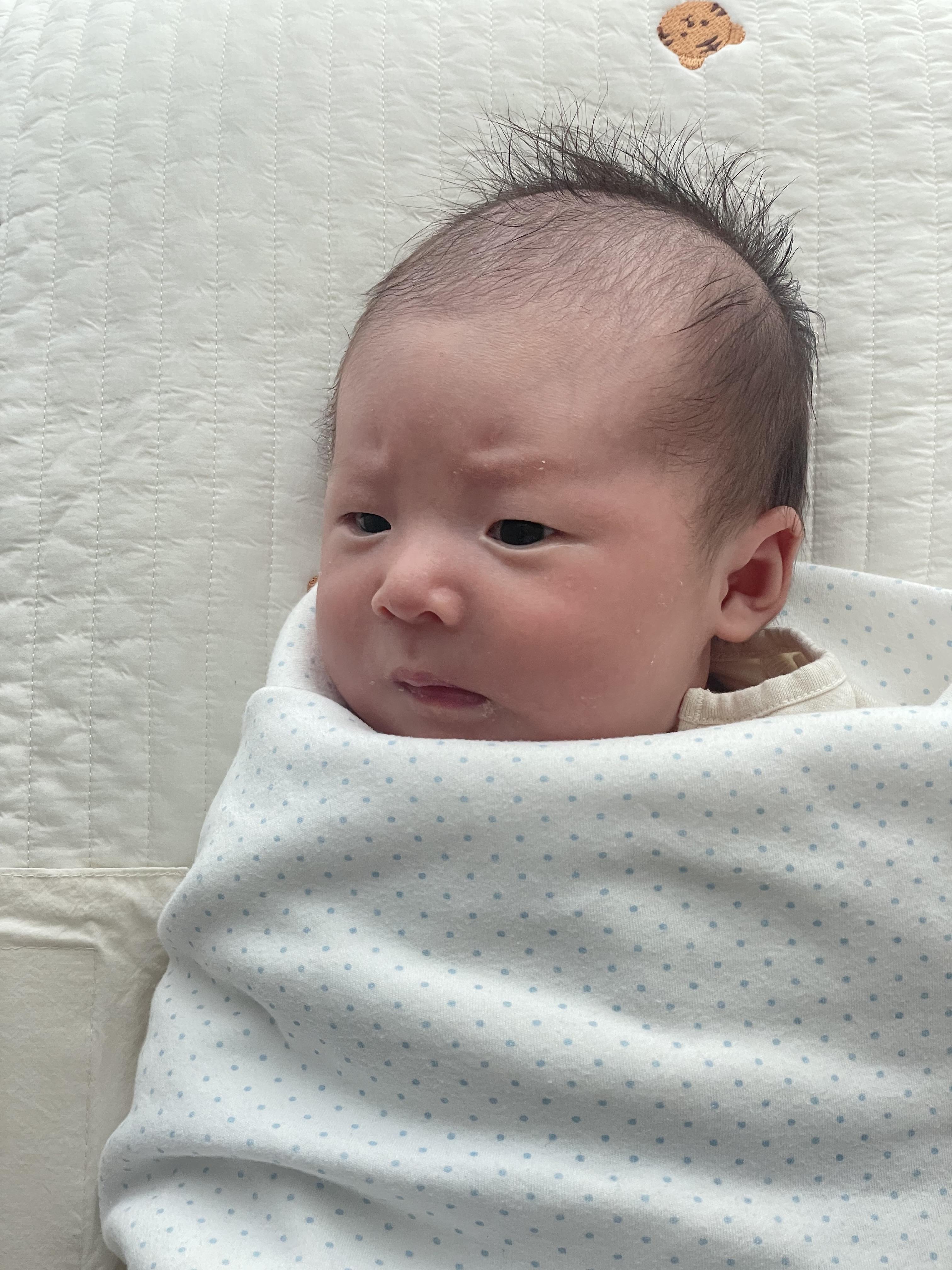 혈관종 에스앤유 피부과