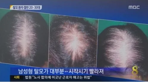 탈모 초기증상 체크리스트 (자가진단 방법)