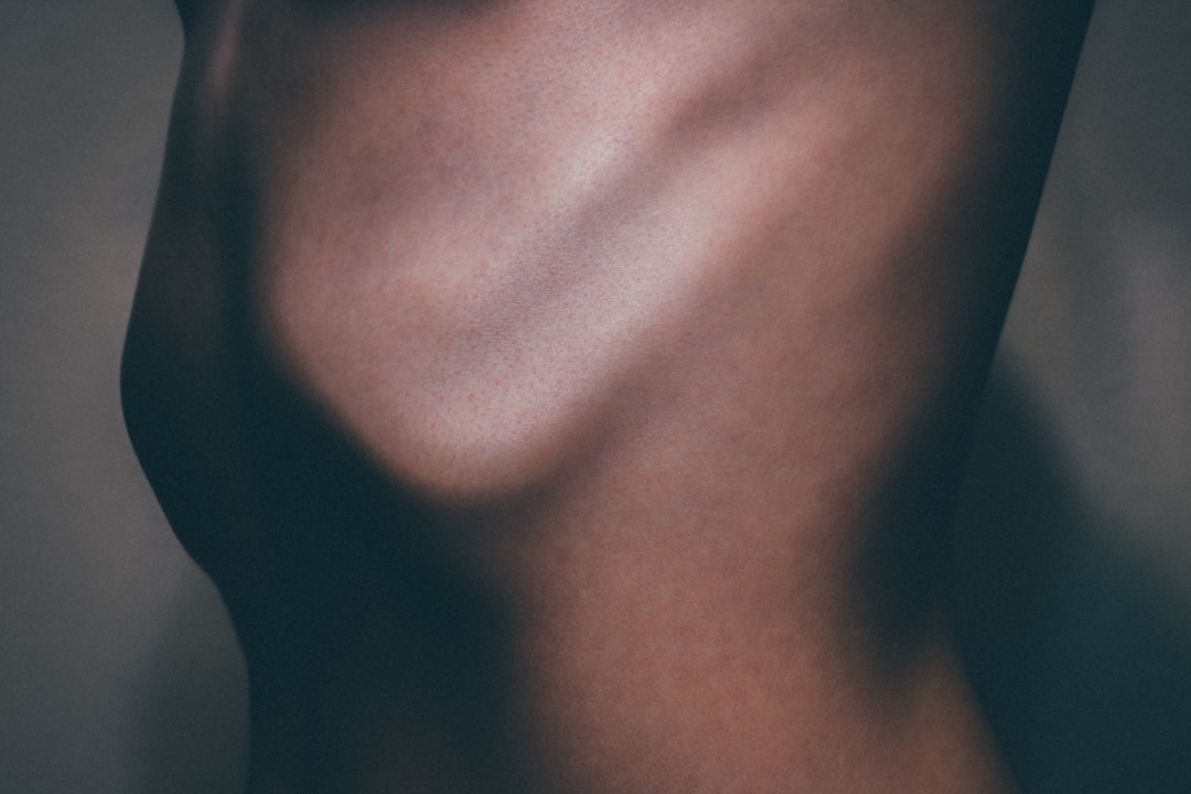Liposuction.