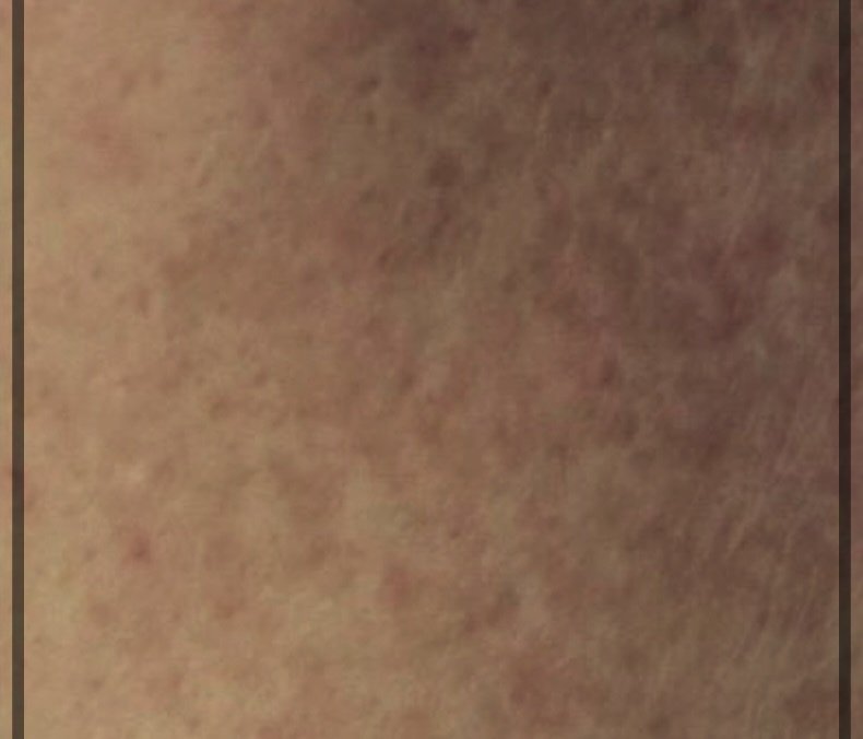 후천성 오타모반 이란?기미. 주금깨 주범.