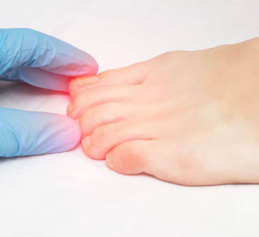 발톱 무좀 레이저 치료