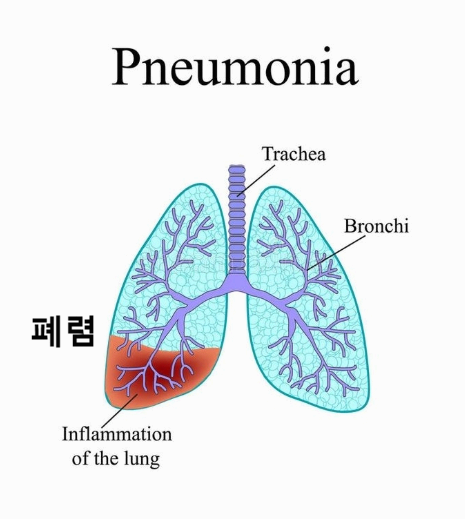 폐렴(Pneumonia) 증상&middot;원인&middot;검사&middot;치료 완벽 정리