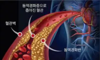 동맥경화-텍스트2
