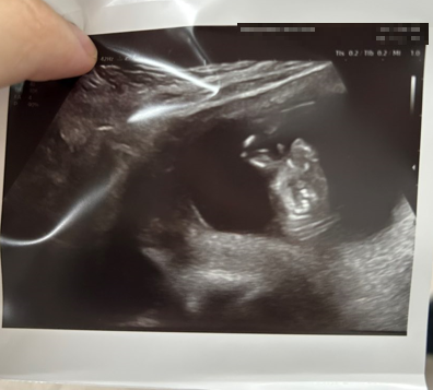 임신 12주 니프티(NIPT) 검사 비용, 후기