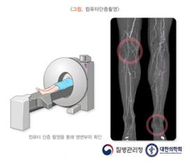 버거병(폐색혈전혈관염)