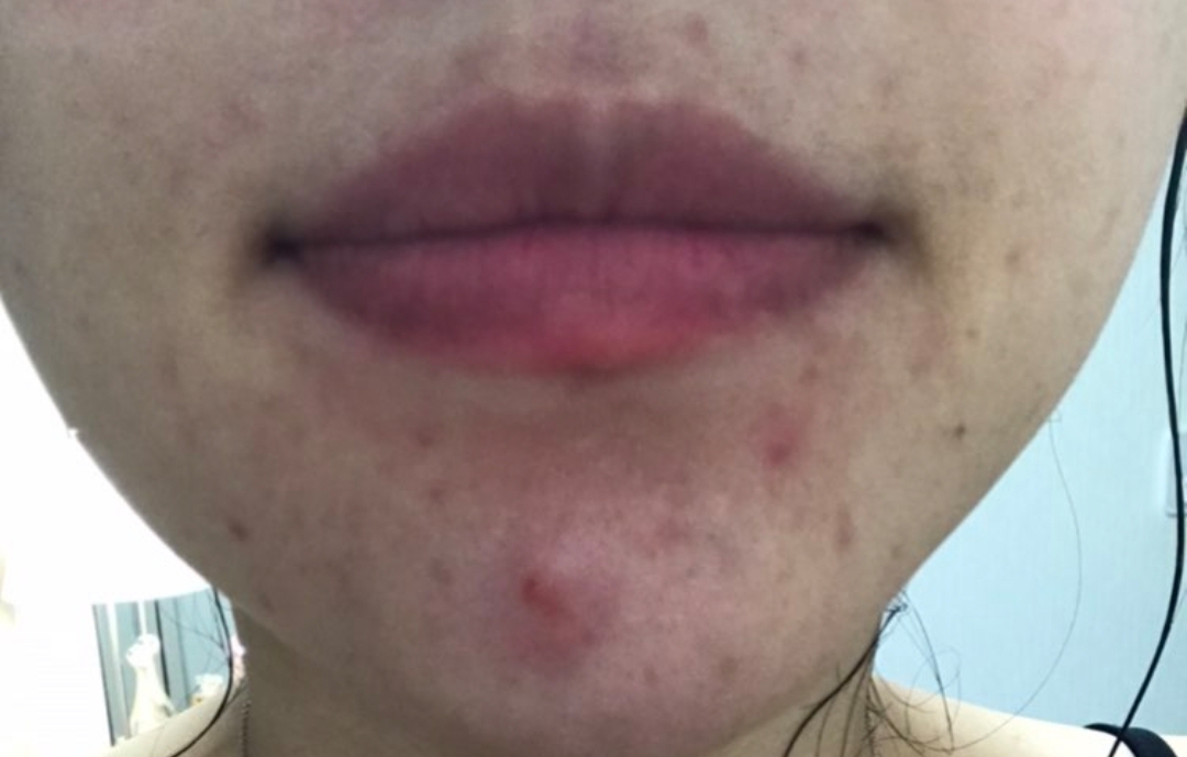 염즘성, 화농성 여드름 피부 관리 및 세안법