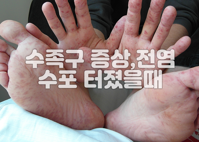 수족구로 인해 손과 발에 발진이 돋은 사진