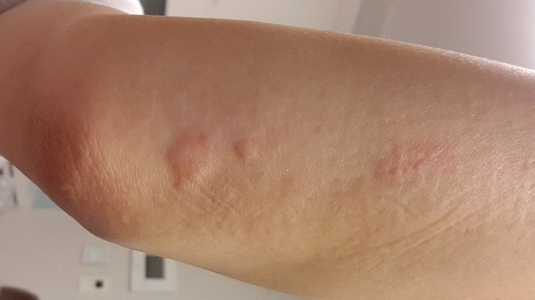 팔에 두드러기가 생긴 모습 사진