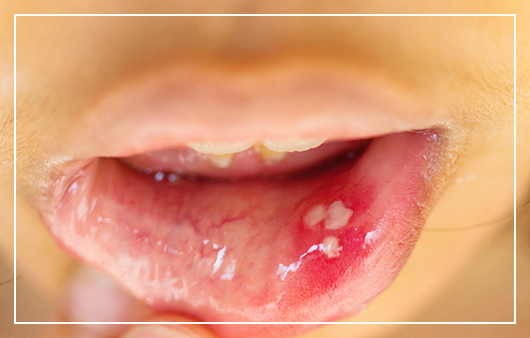 구내염에-좋은-음식