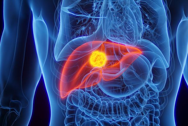 간암 의심 증상 심권호