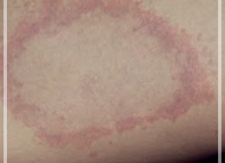 체부백선: 이해, 치료법, 그리고 관리