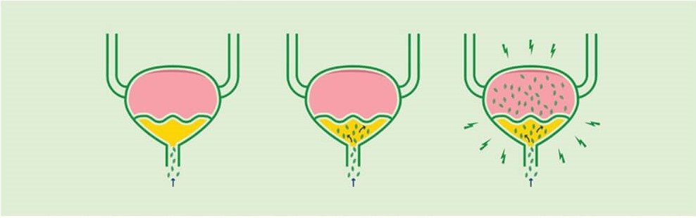 요로감염과 배뇨장애