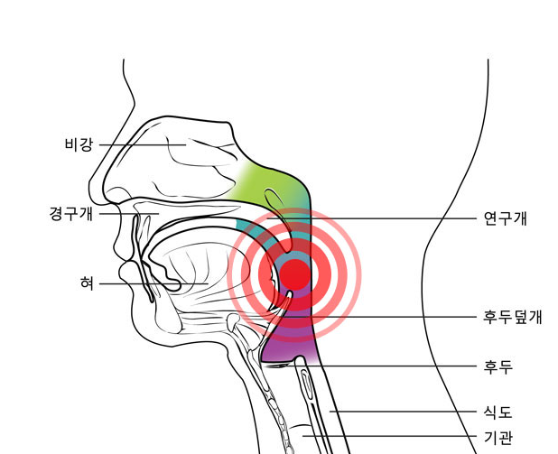 식염수 코세척 부작용