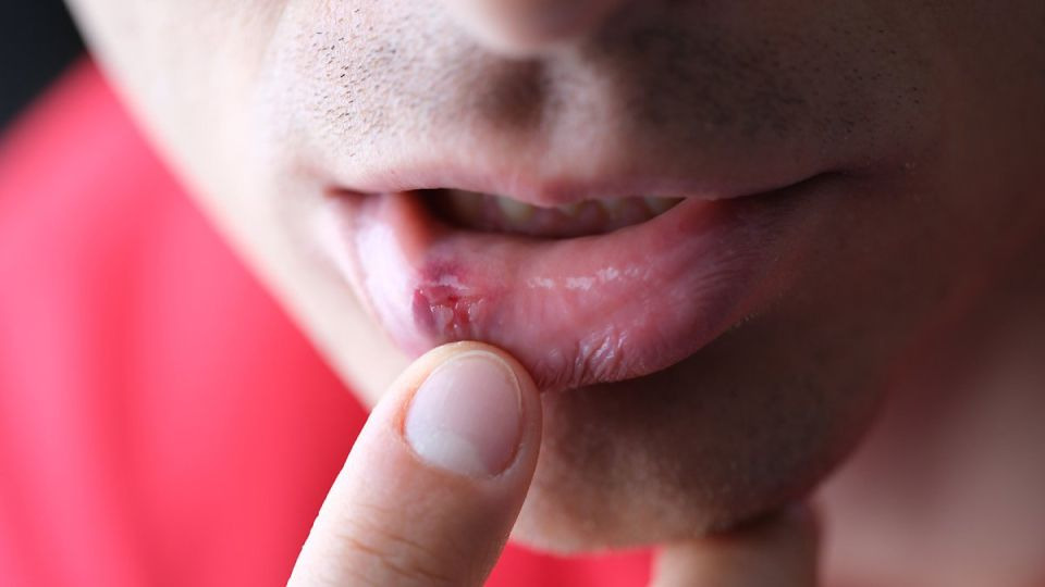 매독 증상 사진