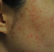 지루성 피부염 완치하려면