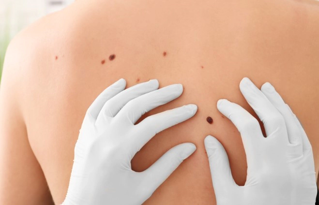 피부암 수술사례