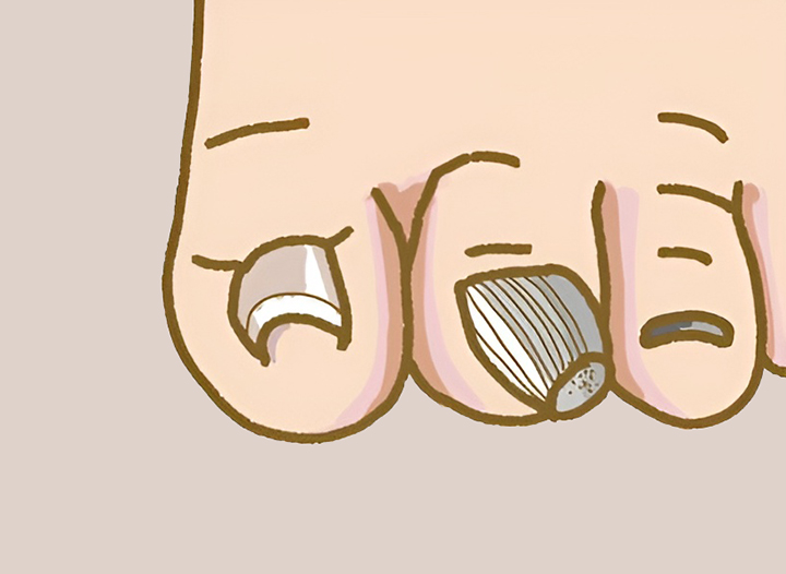 건선으로-두꺼워진-발톱