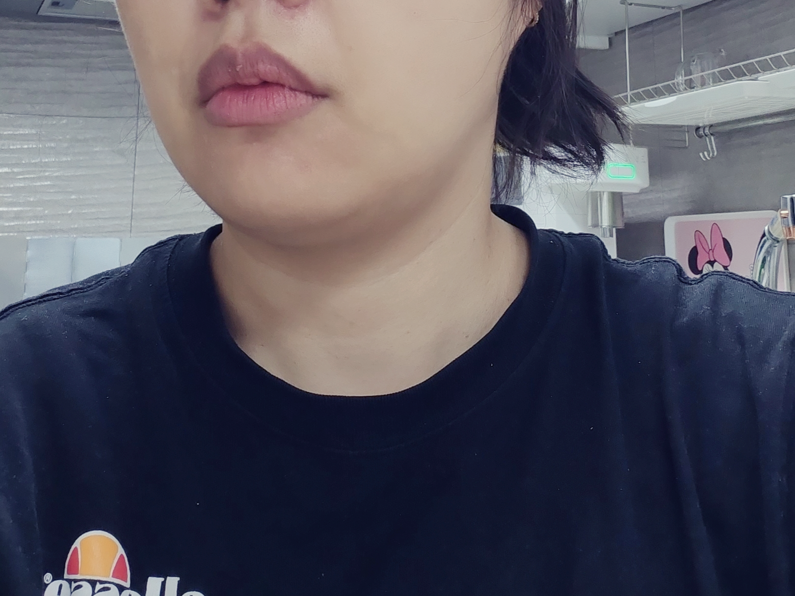 의정부피부과 윤곽주사