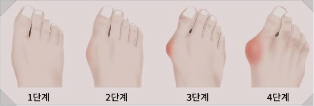 무지외반증 발병과정