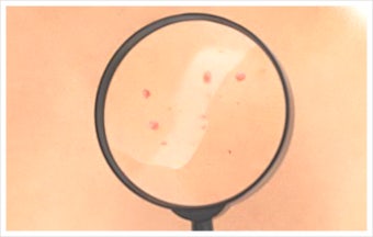 화농성 한선염 치료 수술 병원