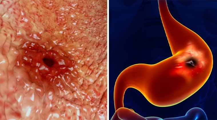 공복 커피 섭취 위벽 손상 역류성 식도염