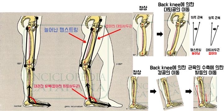 한국인 체형에서 나타는 백니 (back knee)
