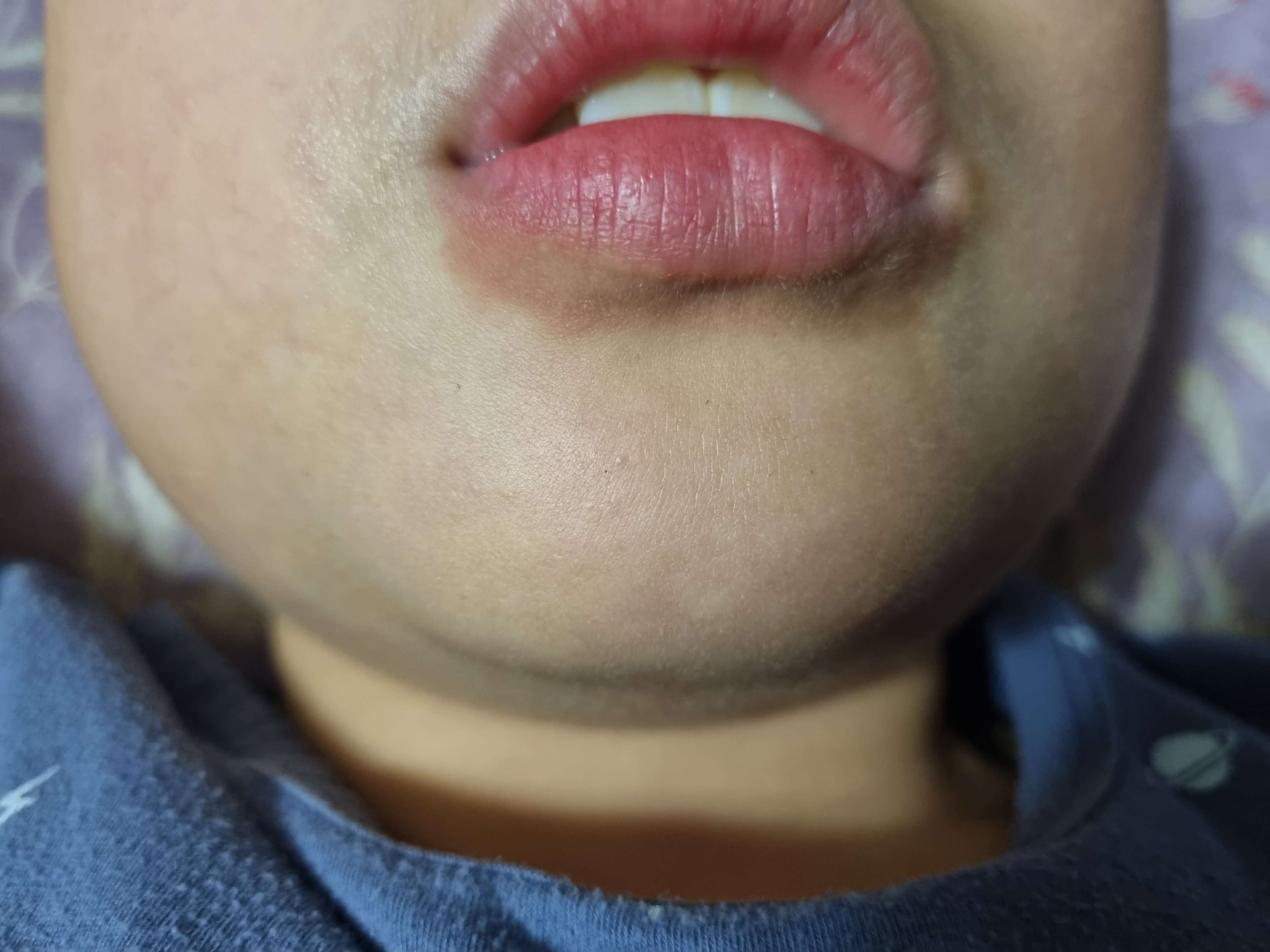 입술-주변-착색