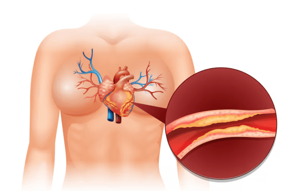 혈관 속 콜레스테롤 찌꺼기 모습
