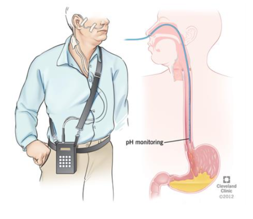 역류성 식도염 원인과 예방