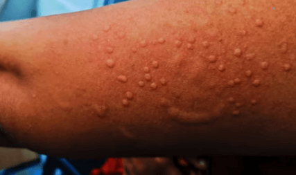 엠폭스 감염 증상으로 팔에 수포가 올라온 사진