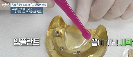 임플란트관리중요