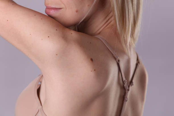 왜 쥐젖이 생길까? 쥐젖 원인부터 제거 방법까지 한눈에 보기!