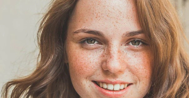 기미 제거 원인