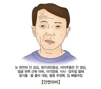 안면 마비 관련 사진
