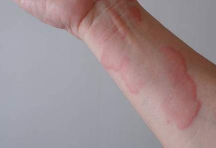 콜린성 두드러기