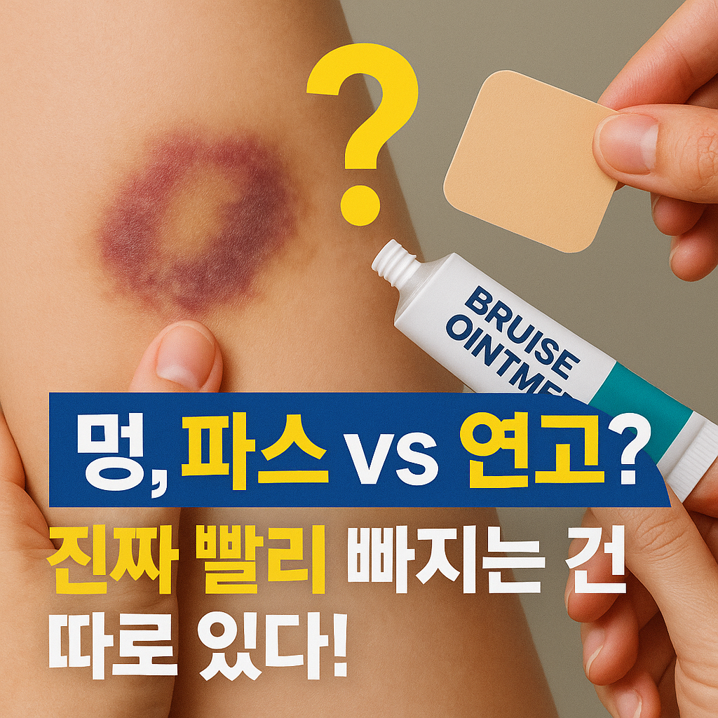 [사이버 보부상 지식+] 멍 빨리 빼는 법, 붙이는 파스 vs 바르는 연고 1시간이 급할 때 정답 알려드림 (원리, 성분, 꿀팁 총정리)